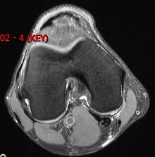 Figure 2 for case Semitendinosus tendon tear, retracted( RID2717 )